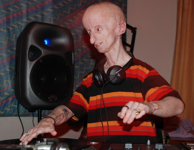 The 15-Year-Old Boy with the Body of an Old Man: 10 People Who Look Like Real-Life Aliens