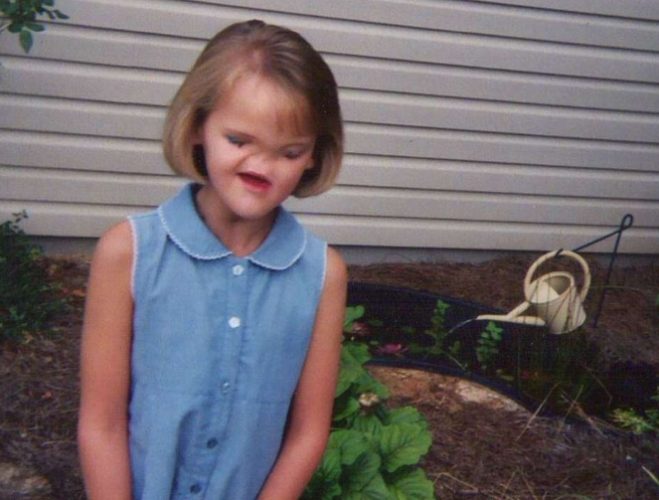 The 15-Year-Old Boy with the Body of an Old Man: 10 People Who Look Like Real-Life Aliens