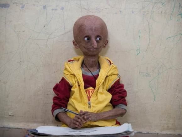 The 15-Year-Old Boy with the Body of an Old Man: 10 People Who Look Like Real-Life Aliens