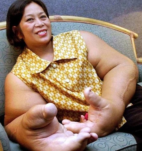 The 15-Year-Old Boy with the Body of an Old Man: 10 People Who Look Like Real-Life Aliens